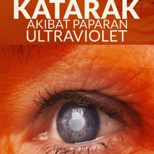 Buku Katarak Akibat Paparan Ultraviolet